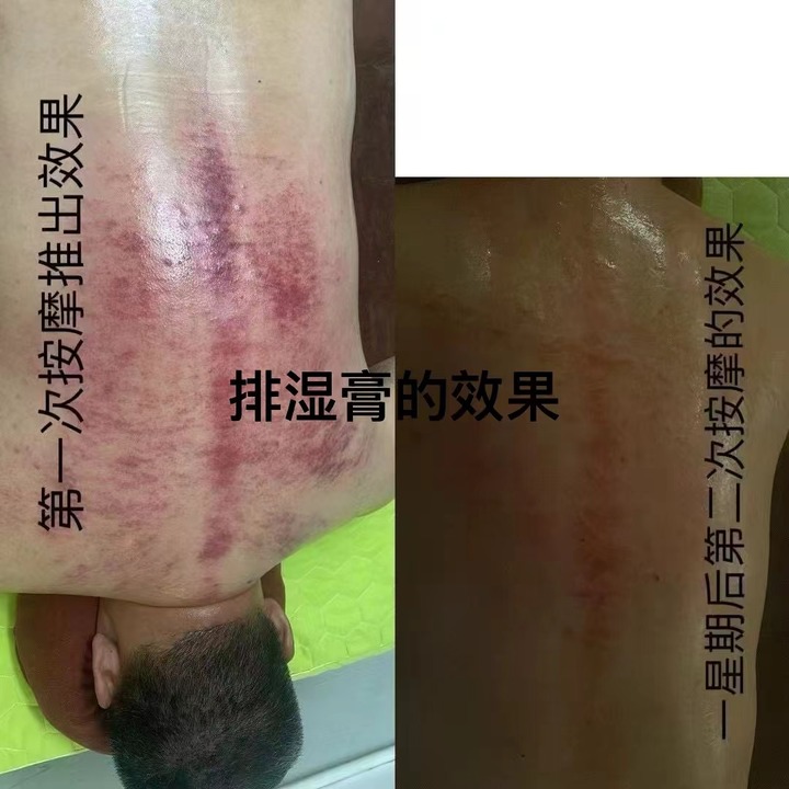 刮痧.jpg